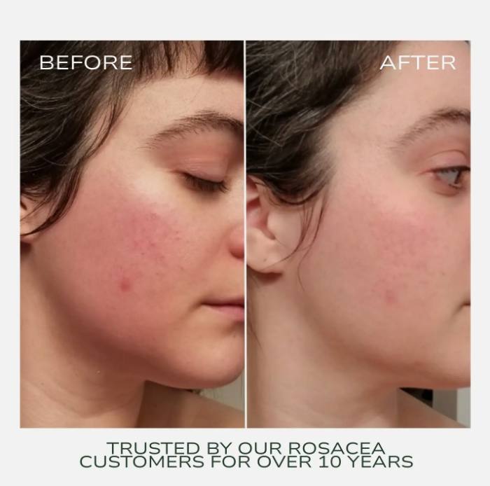 Redness Rescue Cream (Rrc), 45ml